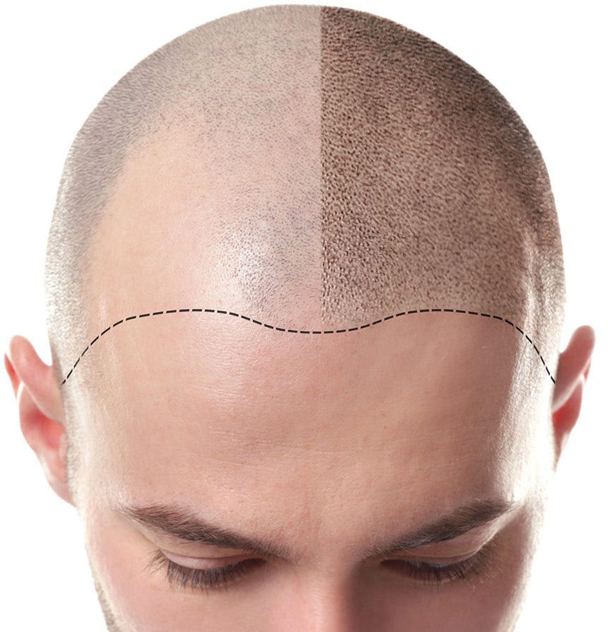 The Art and Science of Scalp Micropigmentation