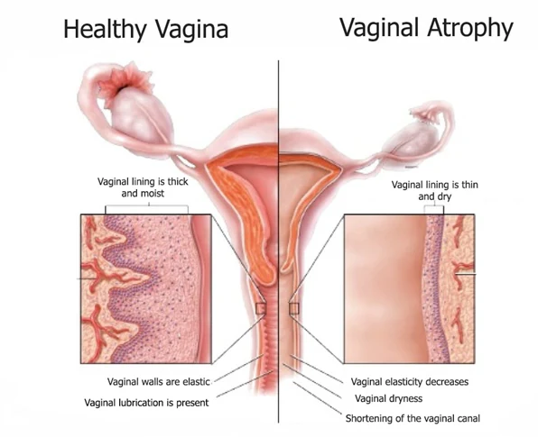 Best Vitamins for Vaginal Health